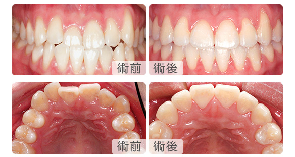 深圳維港箍牙