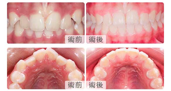 深圳牙齒矯正