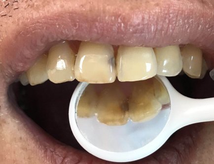 深圳右上前牙樹脂補牙案例