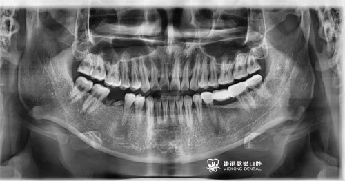 深圳鄭生單顆種牙案例
