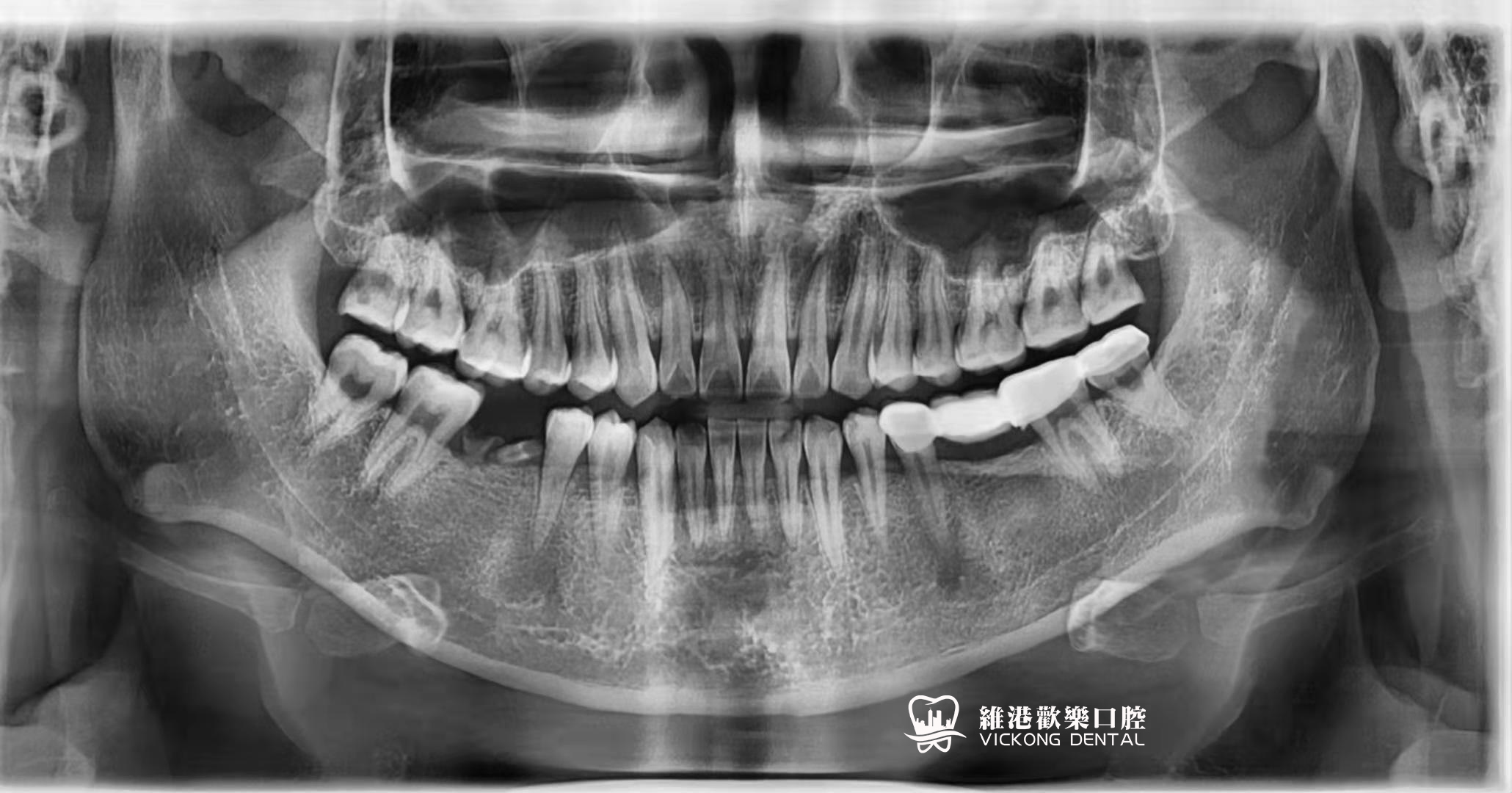 深圳鄭先生單顆種牙案例