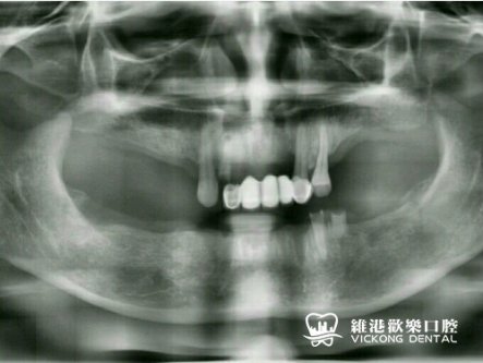 香港廖女士all-on-4全口植牙案例