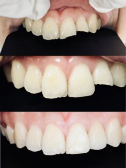 香港黃先生樹脂補牙+美学修复案例