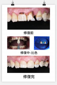 香港叢先生樹脂填充+牙貼面修復案例