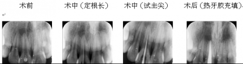 香港唐先生前牙杜牙根案例