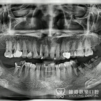 多顆缺牙種植案例分享