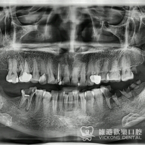 多顆缺牙種植