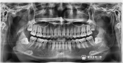 深圳維港拔阻生牙案例分享