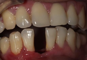 下前牙缺失種植牙修復案例