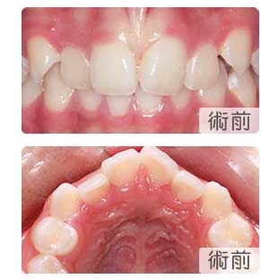 13歲女生深覆合箍牙修復案例