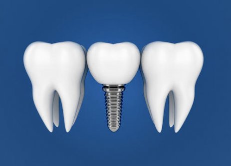 種植牙對比其他修復方式，優點是什麼？又有哪些缺點？