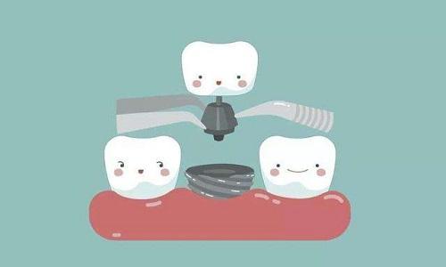 種植牙的適應症、禁忌症