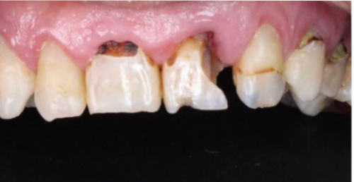香港叢生樹脂填充+牙貼面修復案例