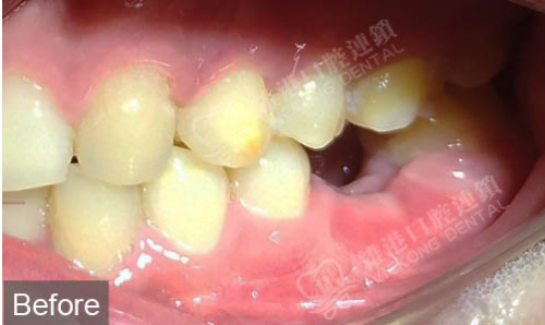 深圳陳先生磨牙即拔即種案例