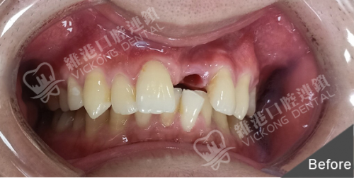 深圳魏先生前牙種植牙案例