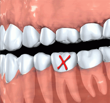 牙齒“三缺一”的危害，你可知到底有多大!