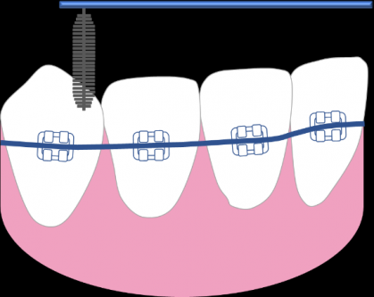矯牙期間，更要認真清潔牙齒！這些工具了解一下？