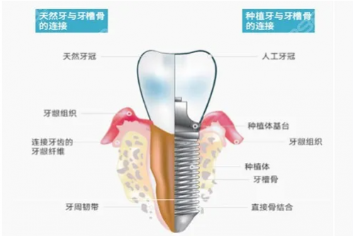 香港正規種牙一顆需要多少錢？看香港正規醫院的種植牙價格表
