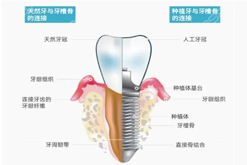 種植牙價格表