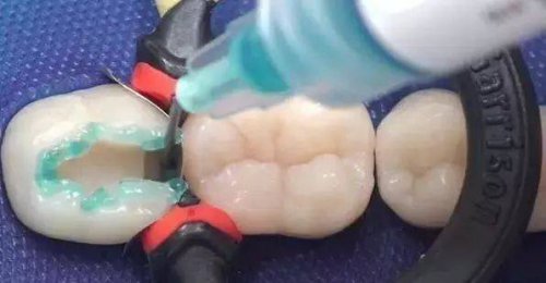香港牙醫科普：補牙後牙痛是正常的嗎?